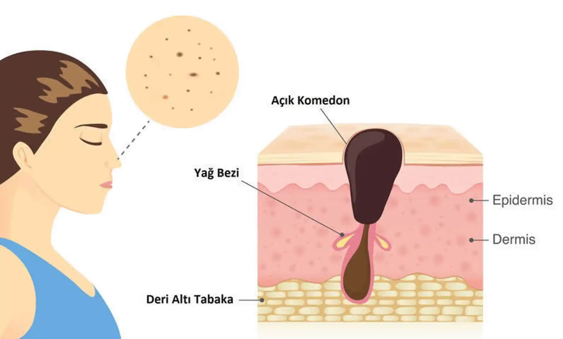 Vücutta Siyah Nokta Nedenleri, Tedavi Yöntemleri ve Önleyici İpuçları