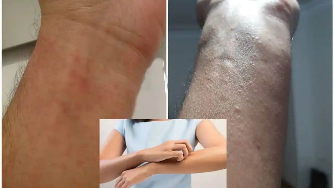 Vücutta Yırtıkların Nedenleri ve Kozmetik Çözüm Yöntemleri Hakkında Bilgiler