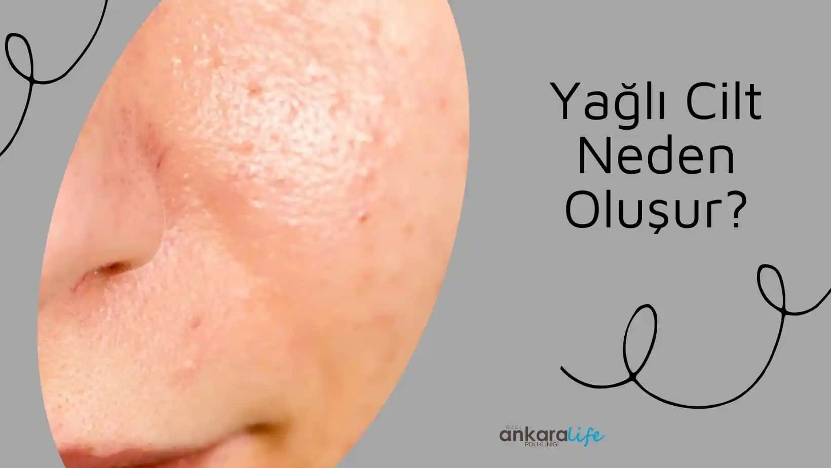 Yağlı Cilt Nasıl Anlaşılır ve Etkili Bakım Yöntemleri Nelerdir