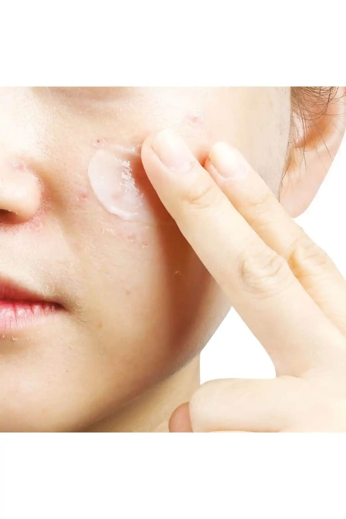 Yağlı ve Sivilceli Ciltler İçin Uygun Nemlendirici Seçimi ve Bakım İpuçları