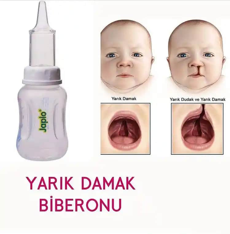 Yarık Damak ve Dudak Tedavisi: Estetik ve Fonksiyonel Yaklaşımlar