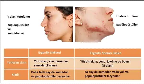 Yetişkinlikte Yüz Aknesi: Nedenleri, Belirtileri ve Etkili Tedavi Yöntemleri