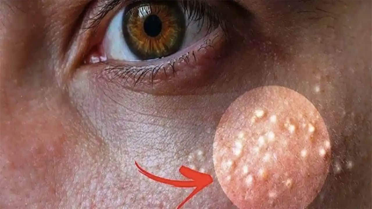 Yüzde Sebum Birikmesi ve Cilt Sağlığını Etkileyen Faktörler