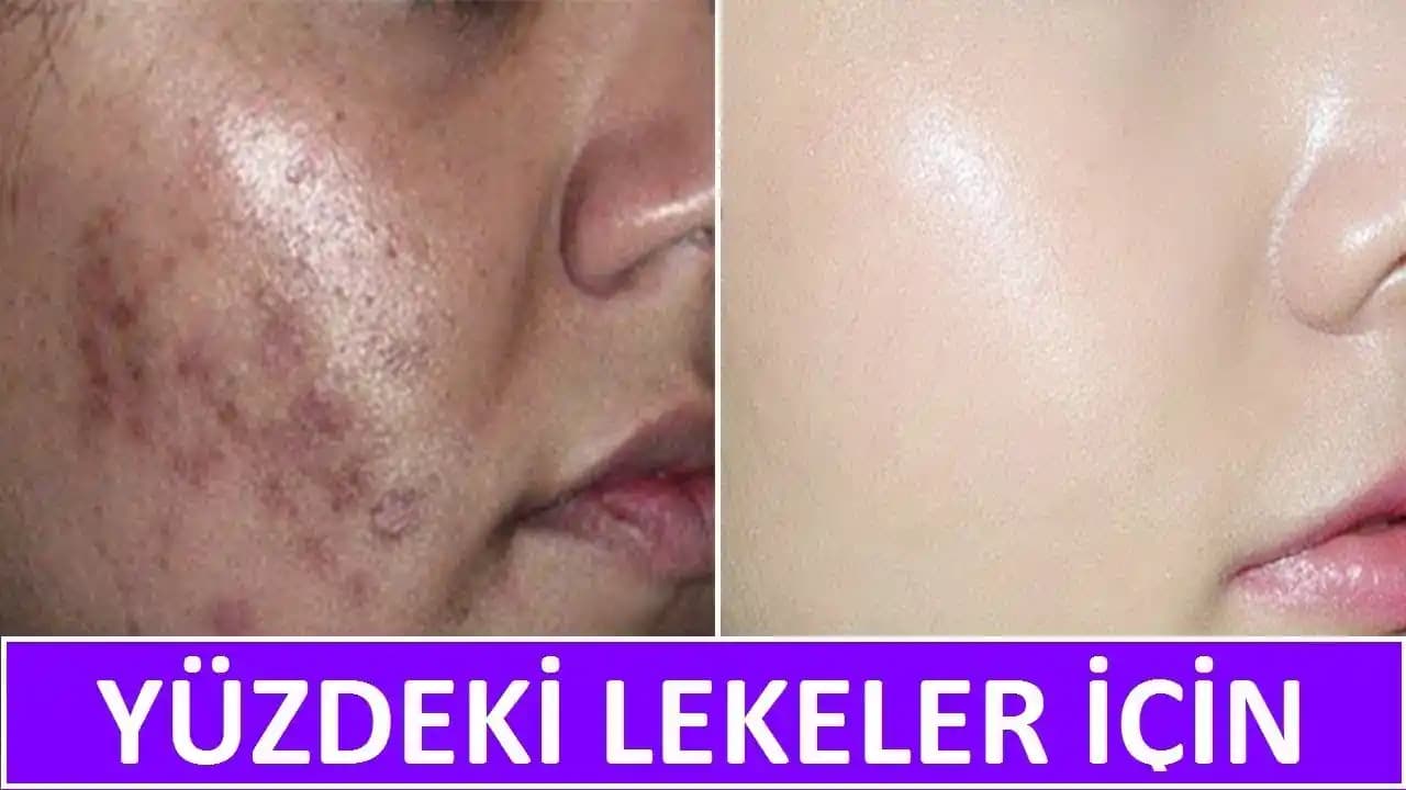 Yüzdeki Kahverengi Lekeler İçin En İyi Kremler ve Doğru Seçim Rehberi
