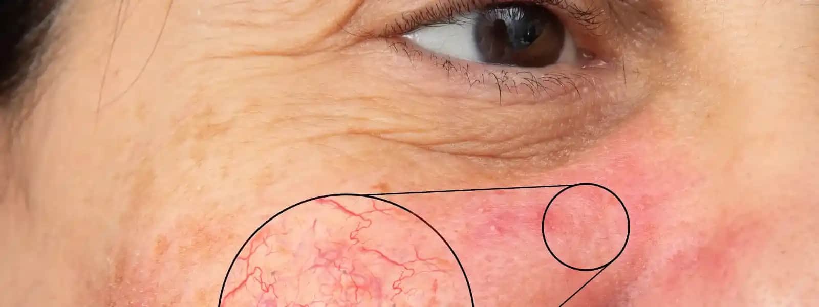 Yüzdeki Kuruluk ve Kızarıklık İçin Etkili Çözüm Yöntemleri ve Bakım İpuçları