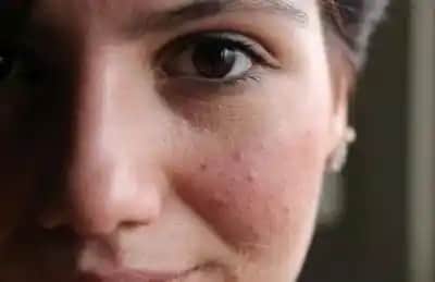 Yüzdeki Pütürleri Azaltan Doğal ve Etkili Maske Tarifleri ve Bakım İpuçları