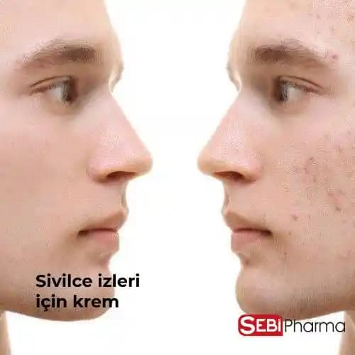 Yüzdeki Sivilce İzleri İçin En Etkili Kremler ve Doğal Çözümler Rehberi