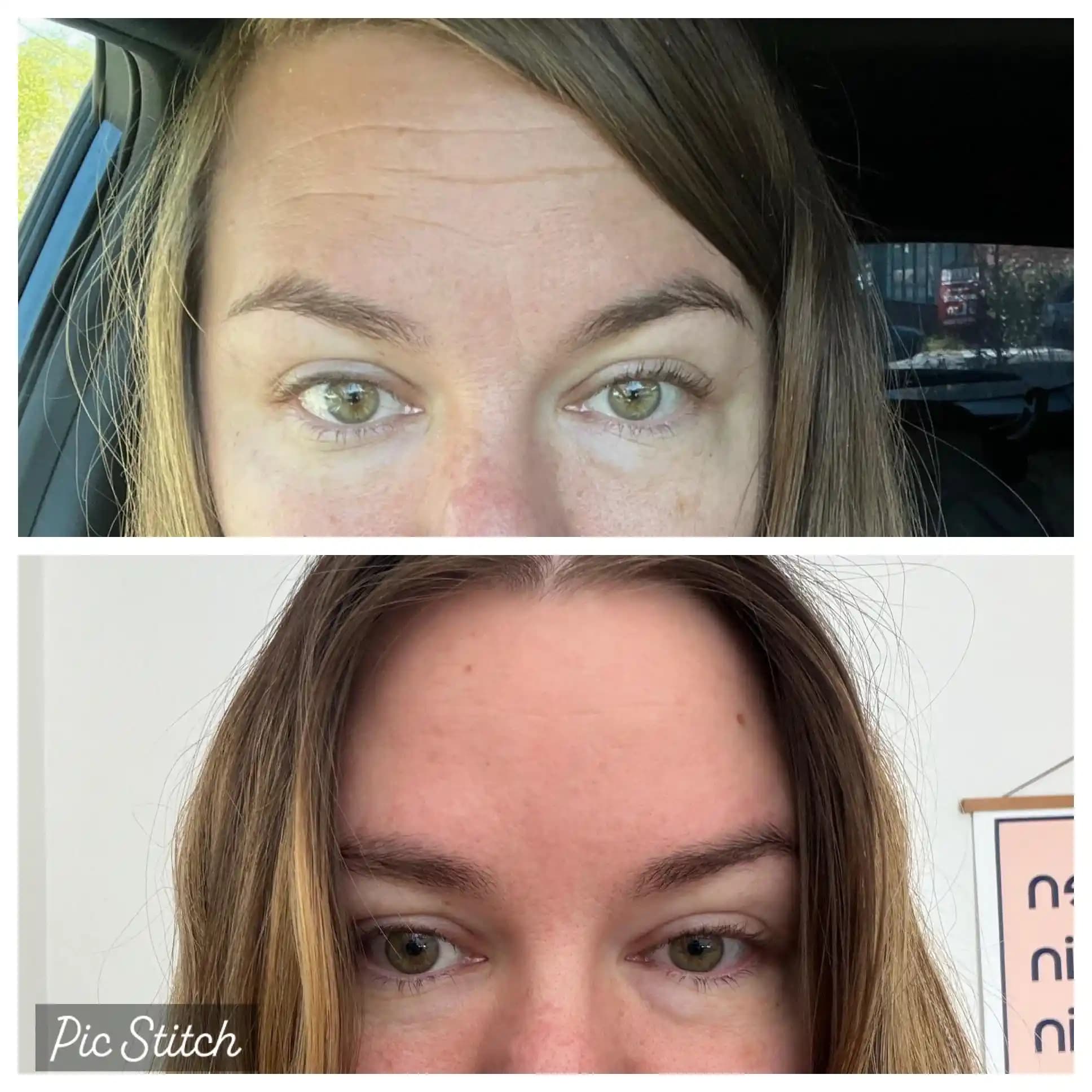 4 Yıllık Baby Botox (Xeomin) ve Kapsamlı Cilt Bakım Rejimi Değerlendirmesi