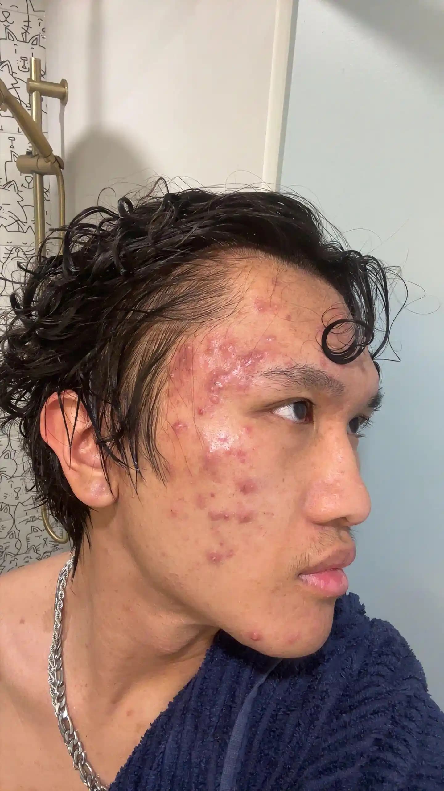 Akne Ağrısını Azaltma Yöntemleri ve Dermatolojik Tedavi Yaklaşımları