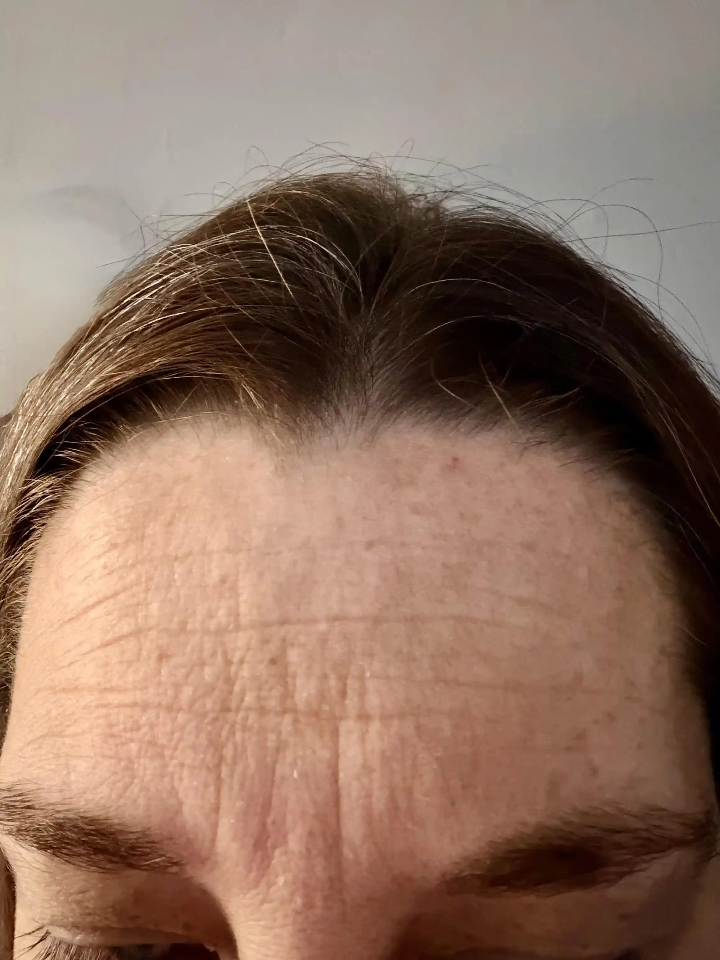 Alın Kırışıklıkları: Nedenleri, Önleme Yöntemleri ve Etkili Tedavi Seçenekleri