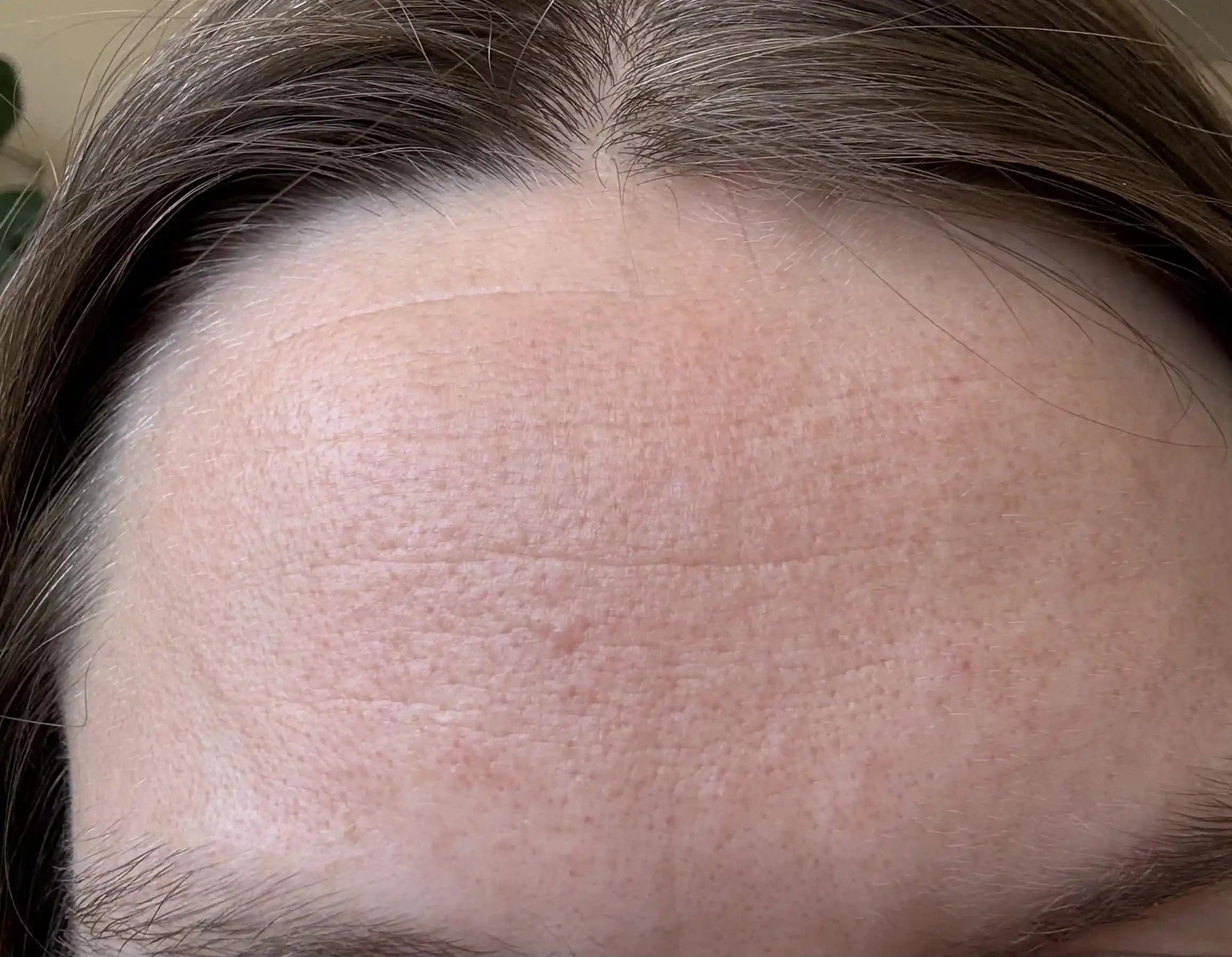 Alın Kırışıklıkları ve Kızarıklıklarına Karşı Etkili Cilt Bakımı ve Tedavi Yöntemleri