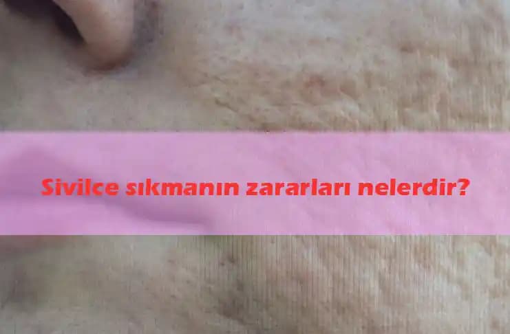 Aşırı Sivilce Sıkma Alışkanlığından Kurtulma Yöntemleri ve Cilt Sağlığına Etkileri