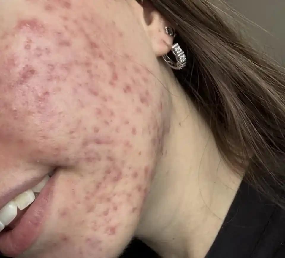 Azelaik Asit ile Akne Tedavisi: Etkileri, Kullanım Rutini ve Cilt Bakımı Önerileri