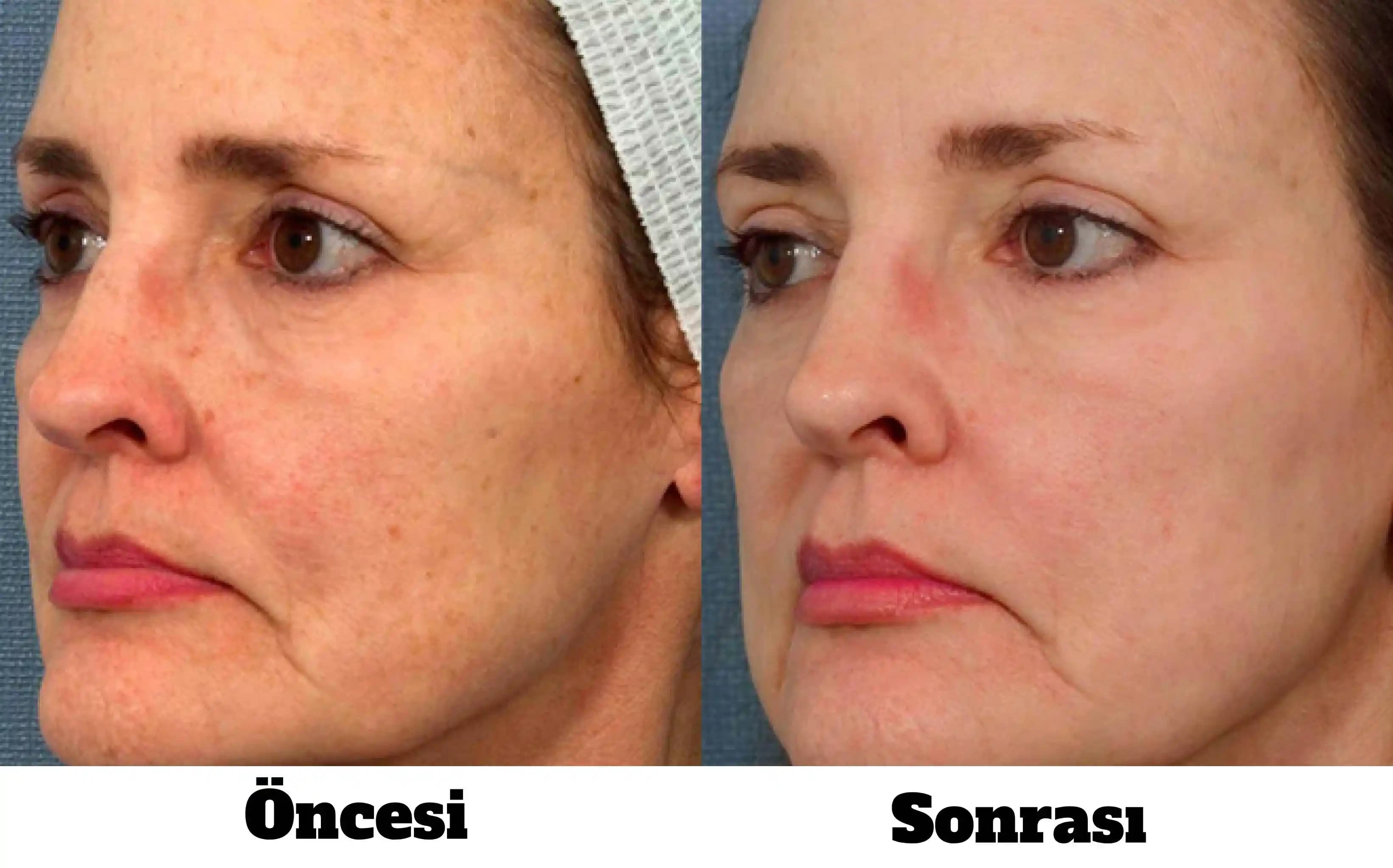 Cilt Gençleştirme Yöntemleri, Estetik Tedaviler ve Sağlık Açısından Değerlendirmeler