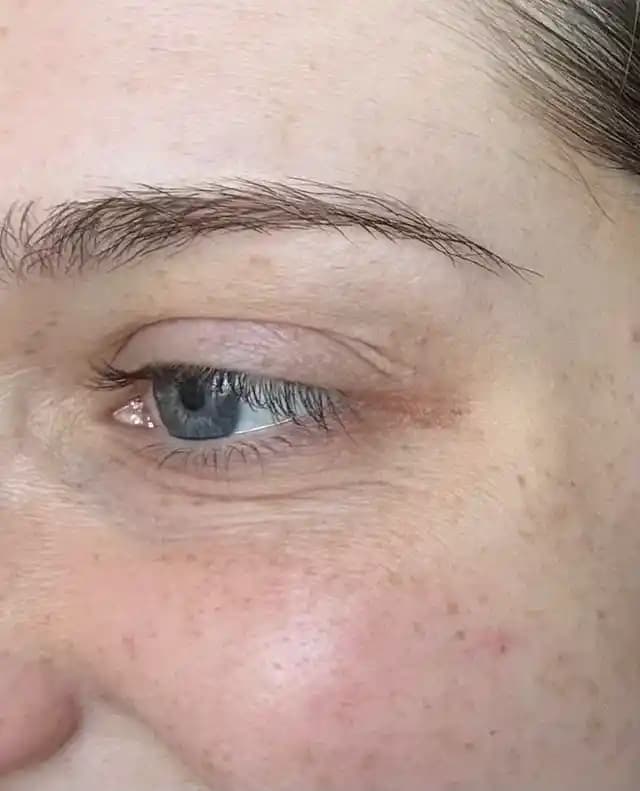 Göz Altı İnce Çizgileri ve Kırışıklıkları İçin Etkili Bakım ve Tedavi Yöntemleri