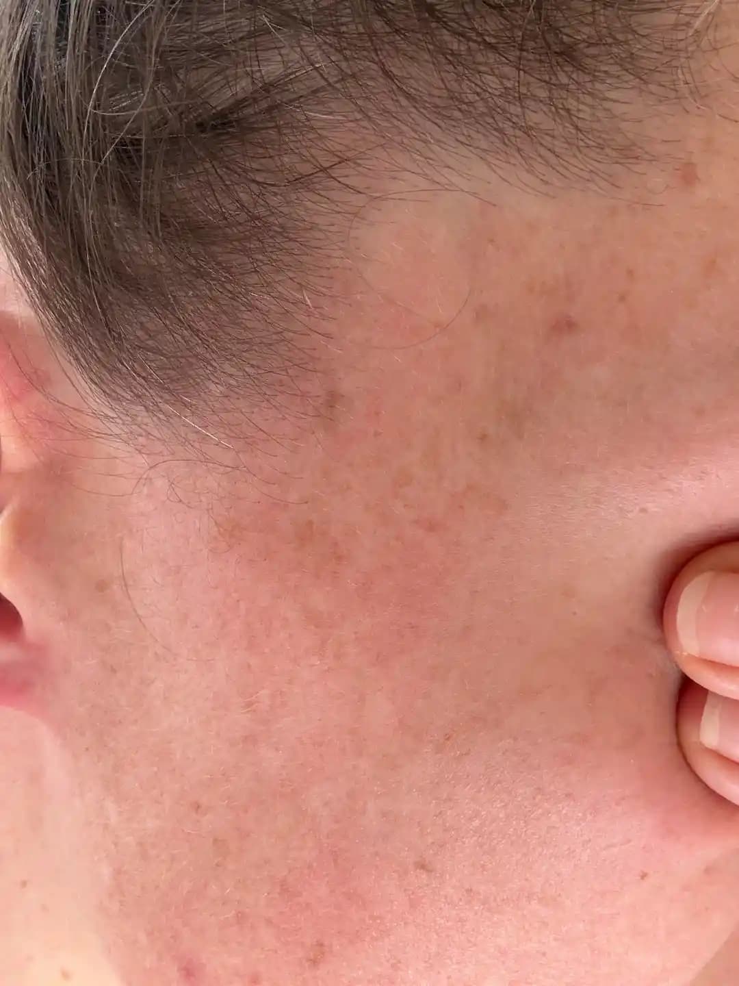 Güneş Hasarına Karşı Cilt Bakımında Etkili Tedavi Yöntemleri ve Ürünler Rehberi