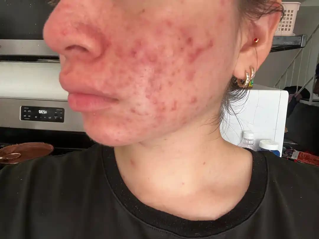 Hormonal Akne Tedavisi: Cilt Bakımı, İlaçlar ve Yaşam Tarzı Yaklaşımları