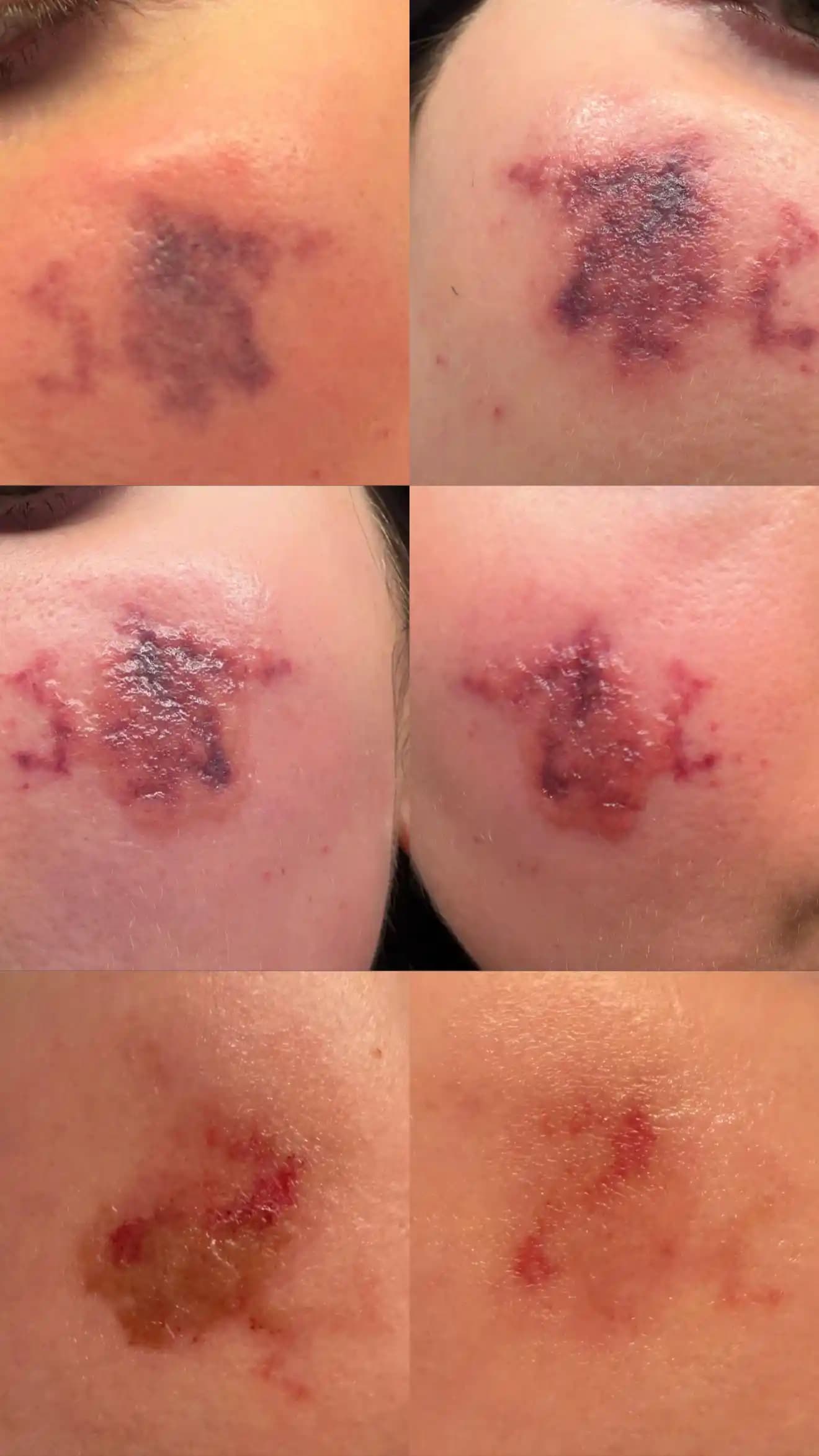 IPL Tedavilerinde Yanık Riski, Nedenleri ve Sonrası Bakım Yöntemleri