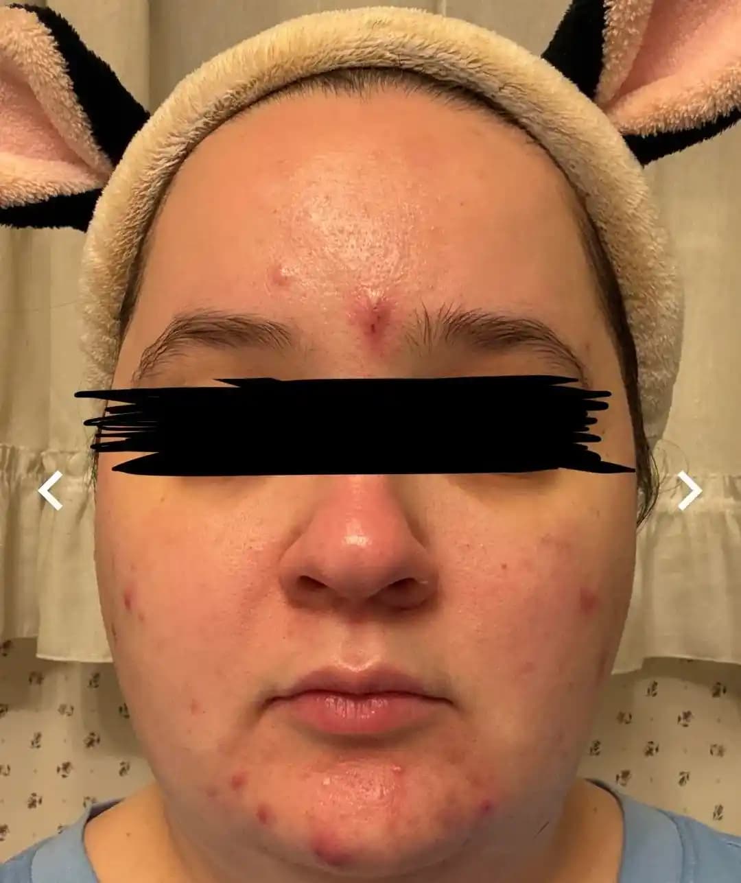 Niasinamidin Kistik Akneye Etkisi ve Cilt Bakımında Dikkat Edilmesi Gerekenler