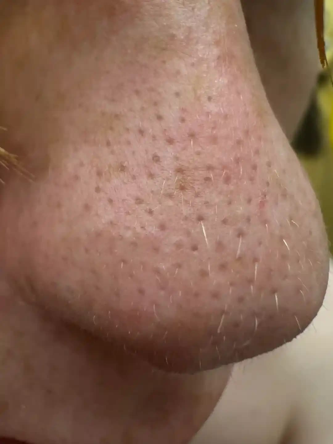 Sebaceous Filamentler Nedir ve Ciltte Görünümünü Azaltma Yöntemleri Nelerdir