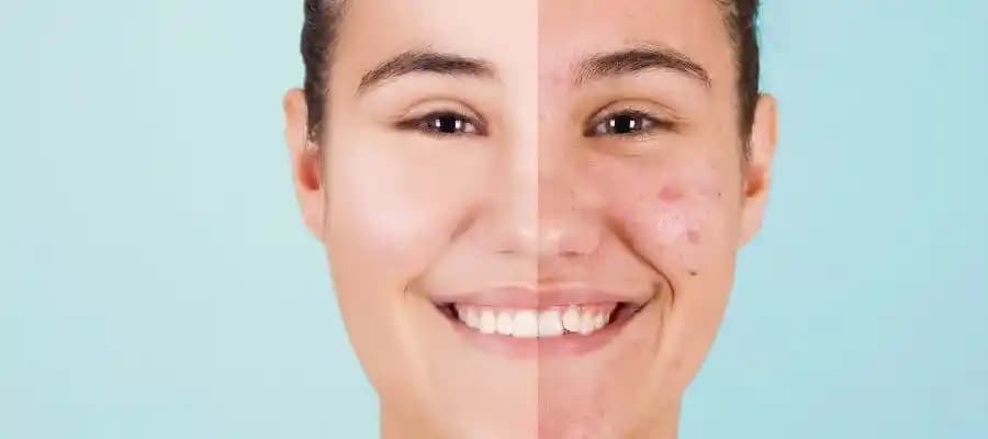 Sivilcenin İyileşip Tekrar Çıkmasının Nedenleri ve Etkili Yönetim Yöntemleri