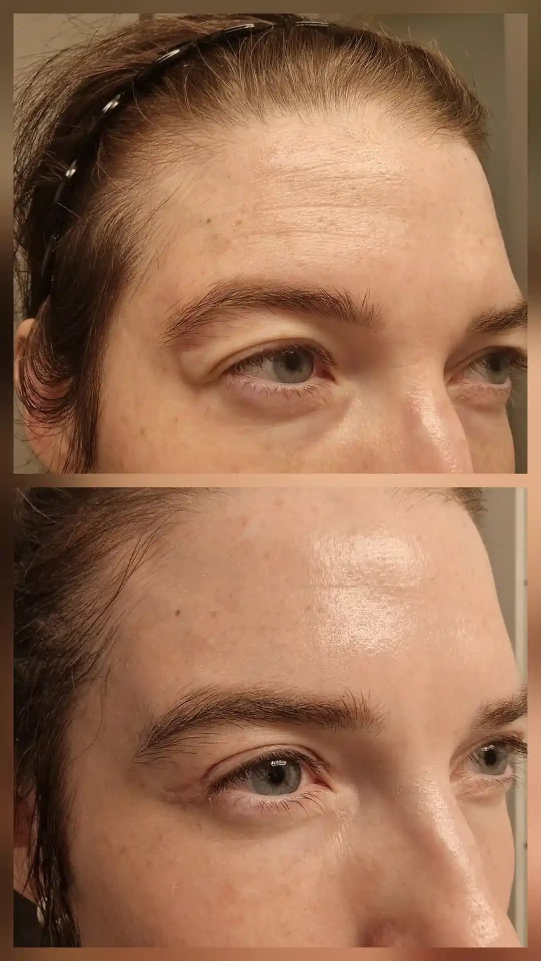 Tretinoin Kullanımı ve Üst Göz Kapağı Estetiğinde Doğal Sonuçlar İçin İpuçları