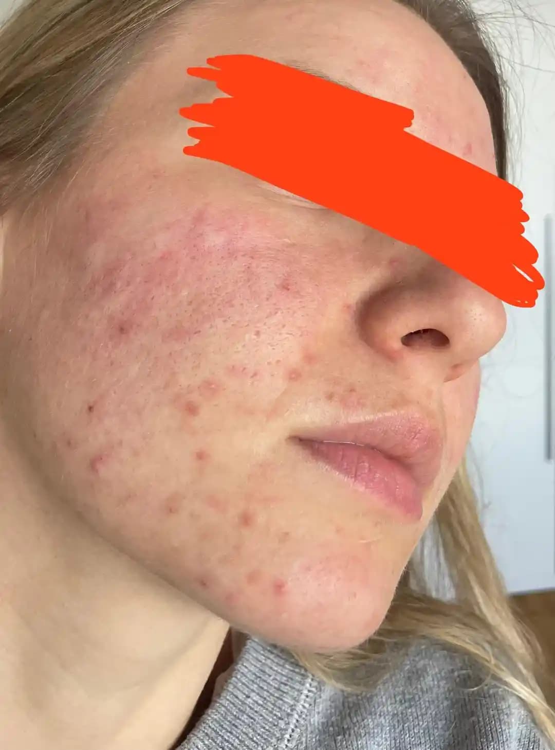 Yetişkinlerde Akne Tedavisi: Hormonal ve Topikal Yaklaşımlar ile Uzman Görüşleri