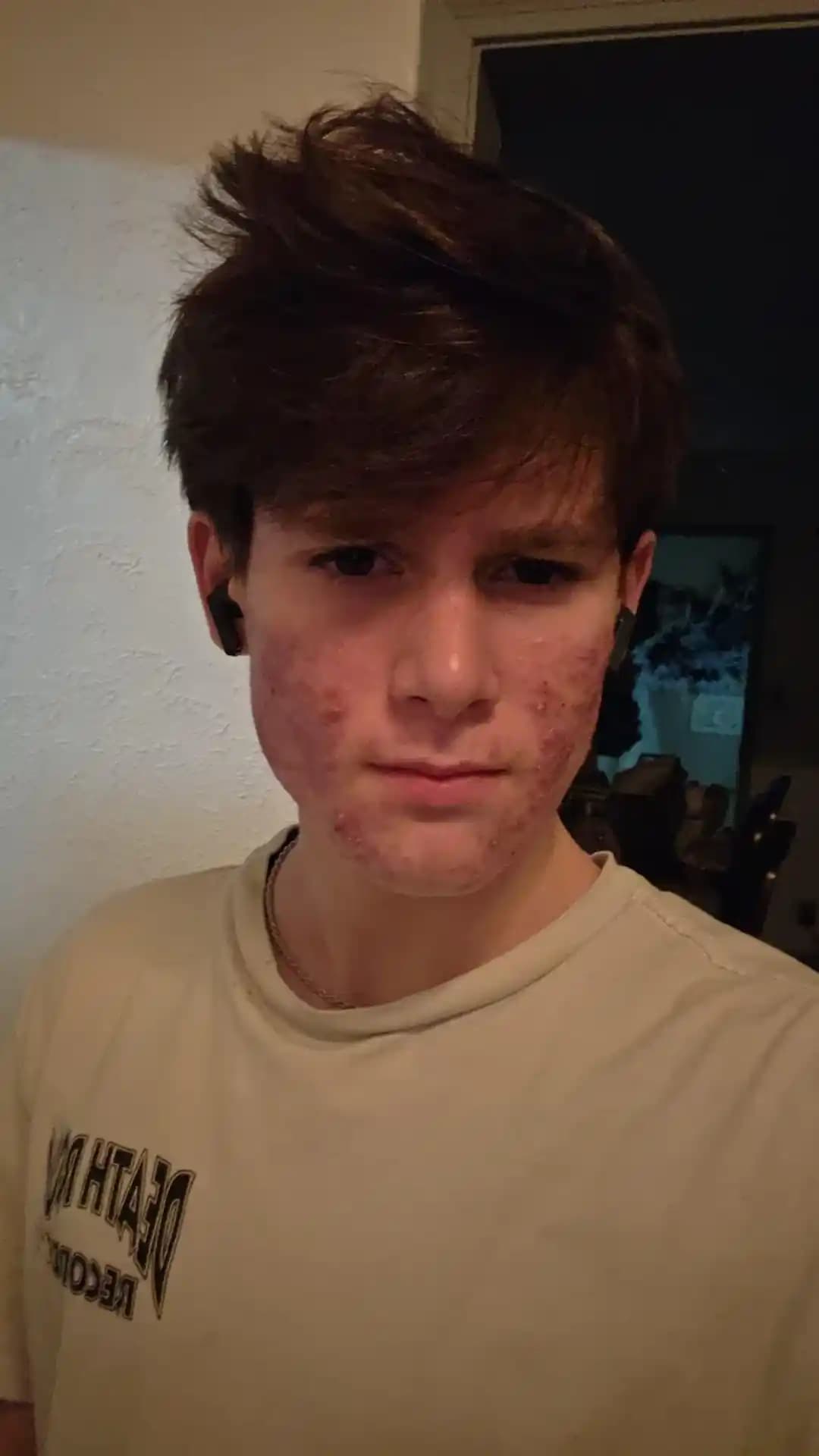 Akne Fulminans ve Accutane Tedavisinde Cilt Bakımı ve Psikolojik Dayanıklılık Yaklaşımları