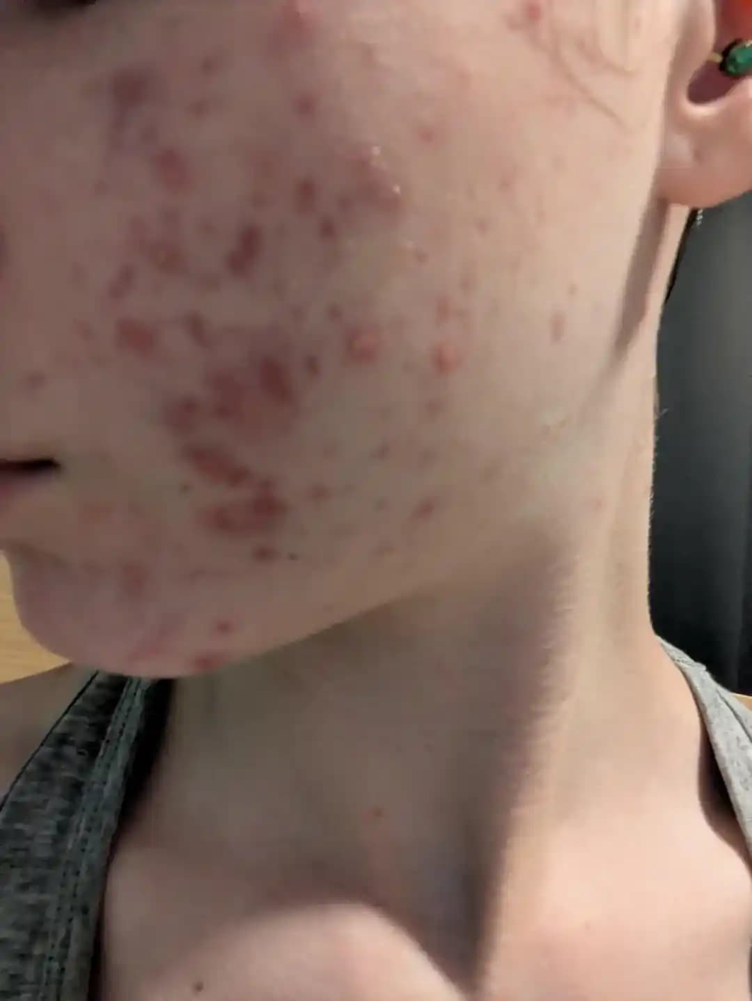 Akne Tedavisinde Beslenme ve Cilt Bakımının Rolü: 5 Yıllık Deneyimden Çıkarımlar