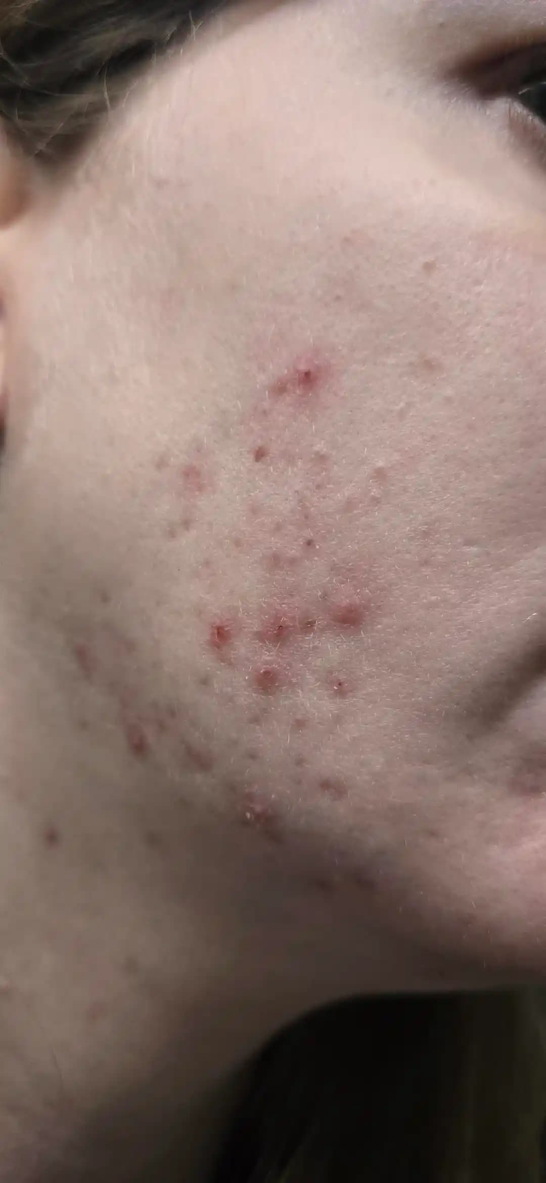 Akne Tedavisinde Dört Aylık Düzenli Cilt Bakım Rutini ve Etkili Ürün Kullanımı