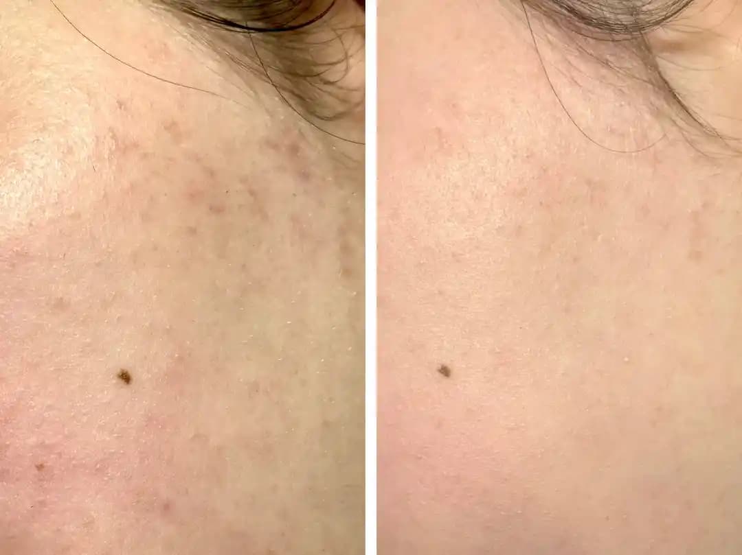 Azelaik Asidin Cilt Dokusu ve Hiperpigmentasyon Üzerindeki Etkileri: 2 Haftalık Kullanım Sonuçları