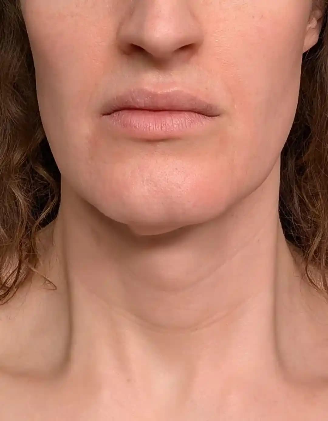 Çene ve Boyun Bölgesinde Sarkan Cilt: Nedenleri, Tedavi Yöntemleri ve Bakım Önerileri