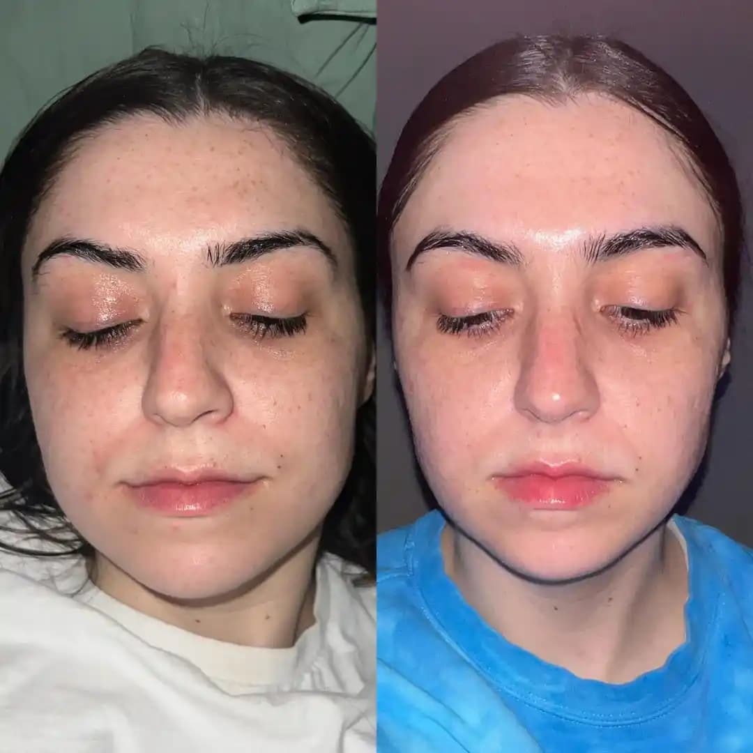 CurrentBody Multi Light LED Maskesi ile 90 Günlük Düzenli Cilt Bakım Deneyimi ve Etkileri