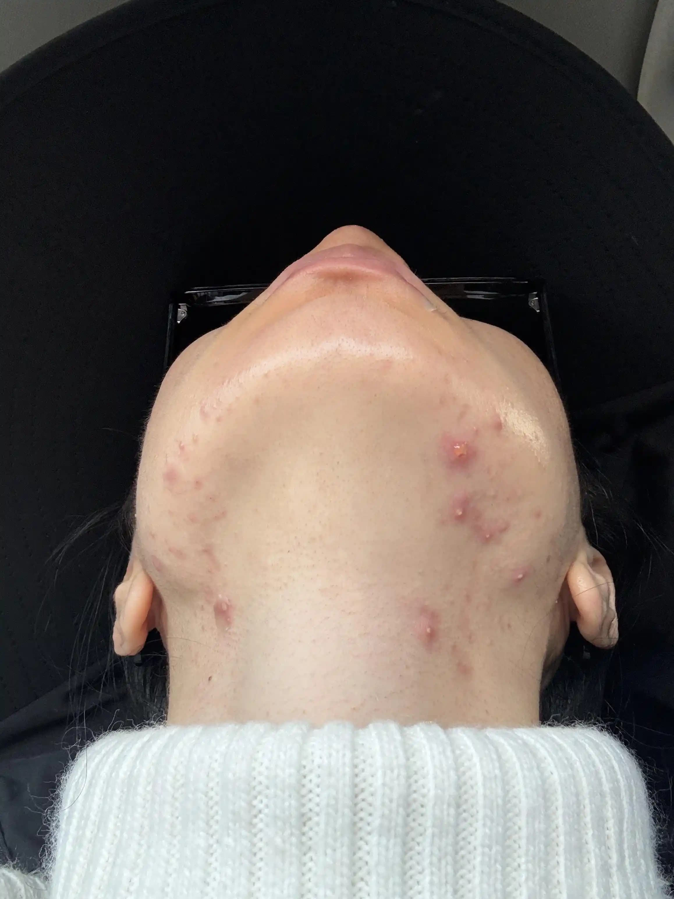 Hormonal Akne Tedavisinde Kullanılan Yöntemler ve Deneyimlerin Değerlendirilmesi