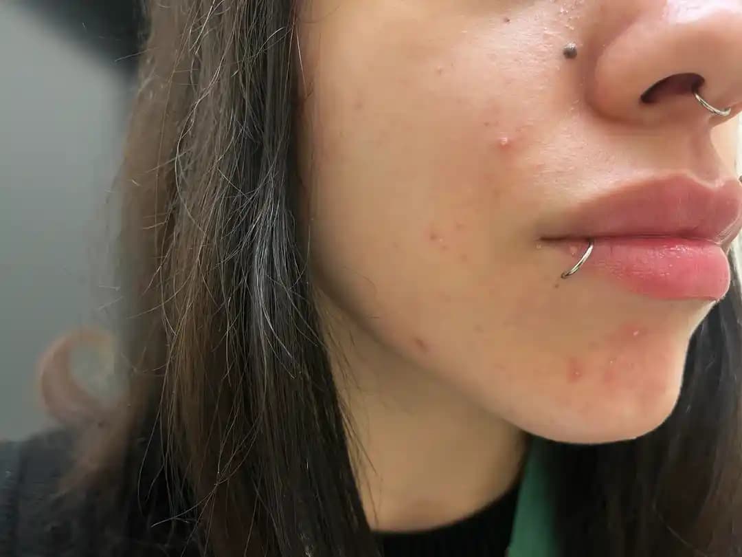 Hormonal Akne ve Cilt Bakımında Etkili ve Nazik Yaklaşımlar