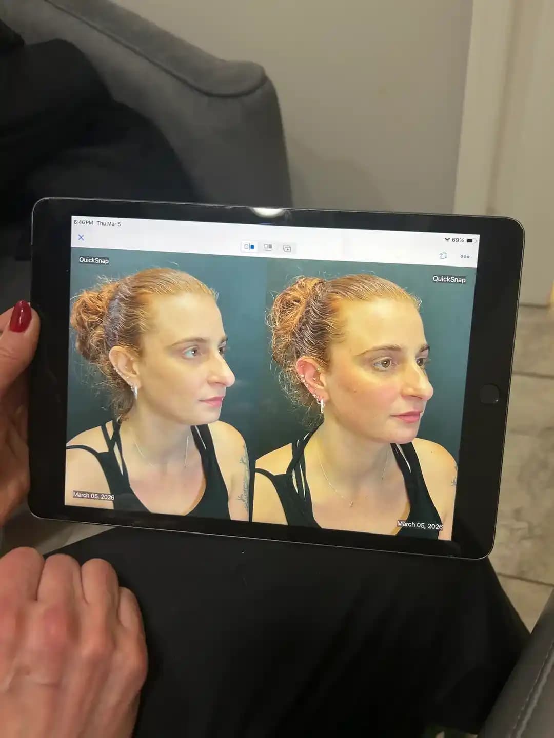 Yüz Dengeleme: Dolgu ile Yüz Estetiğinde Doğal ve Orantılı Görünüm Sağlama