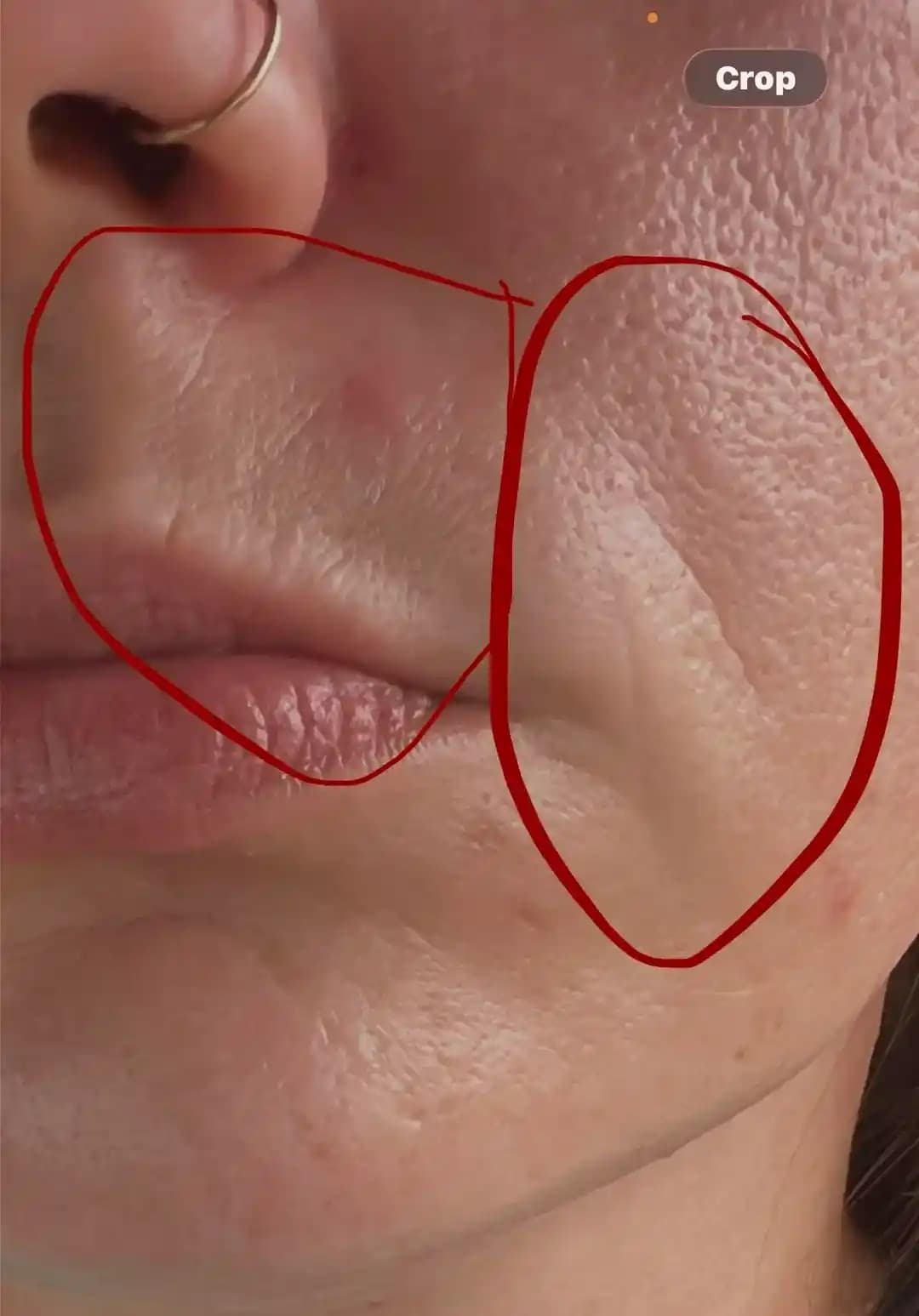 Yüzde Tek Taraflı Kırışıklıkların Nedenleri ve Etkili Tedavi Yöntemleri