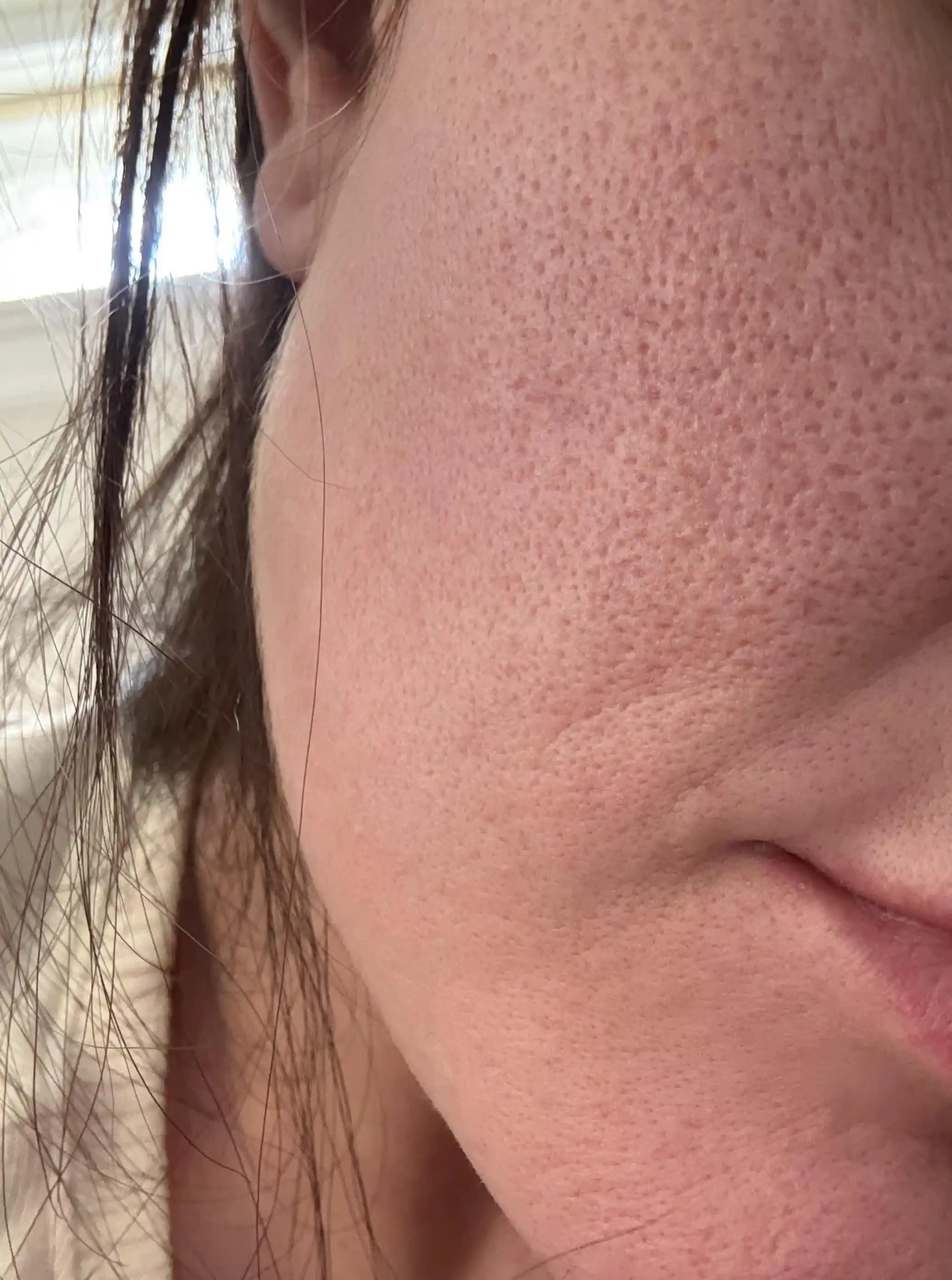 Akne İzleri ve Geniş Gözenekler İçin Etkili Cilt Bakım Yöntemleri ve Tedavi Seçenekleri