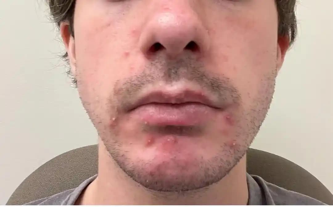 Akne Tedavisinde Güncel Protokoller ve Kişisel Cilt Bakım Rutinleri