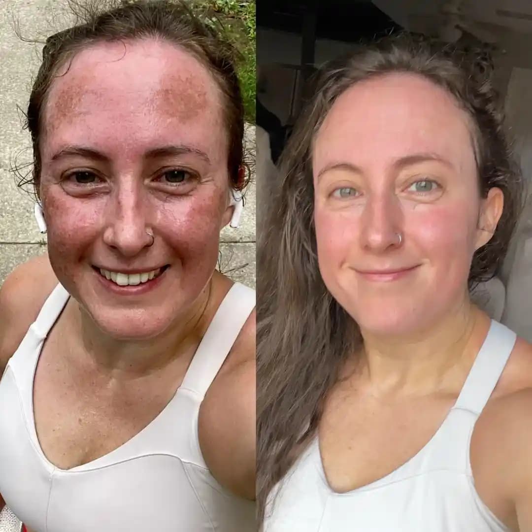 Güneş Koruyucu ve Glikolik Asit Toner ile Hiperpigmentasyon Kontrolü: Etkili Cilt Bakımı Yöntemleri