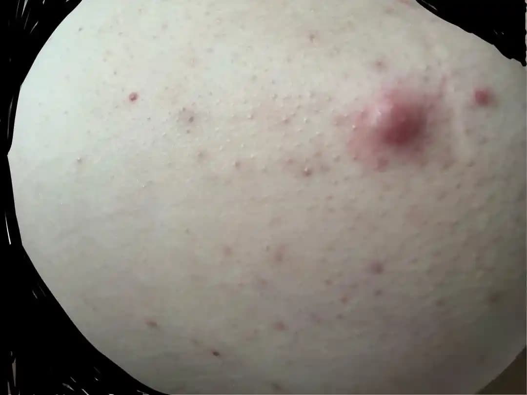 Popo Bölgesinde Ağrılı Folikülit: Nedenleri, Belirtileri ve Etkili Tedavi Yöntemleri