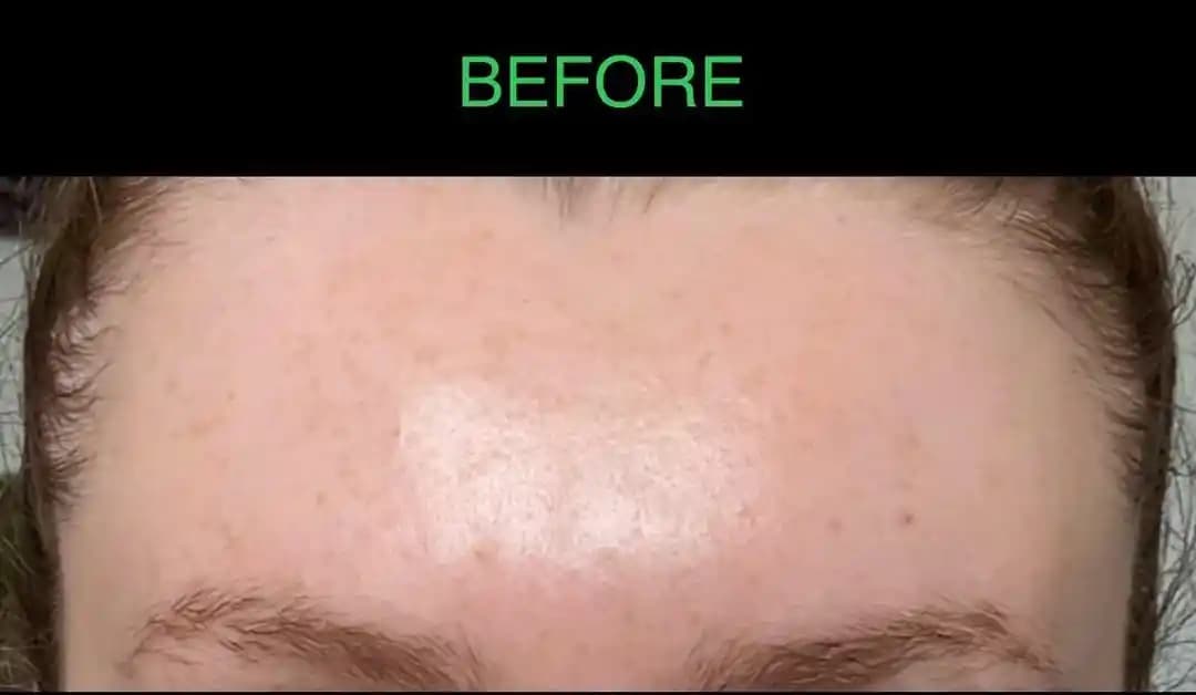 The Perfect Peel: Derinlemesine Cilt Yenileme ve Ton Eşitsizliği Giderme Yöntemi