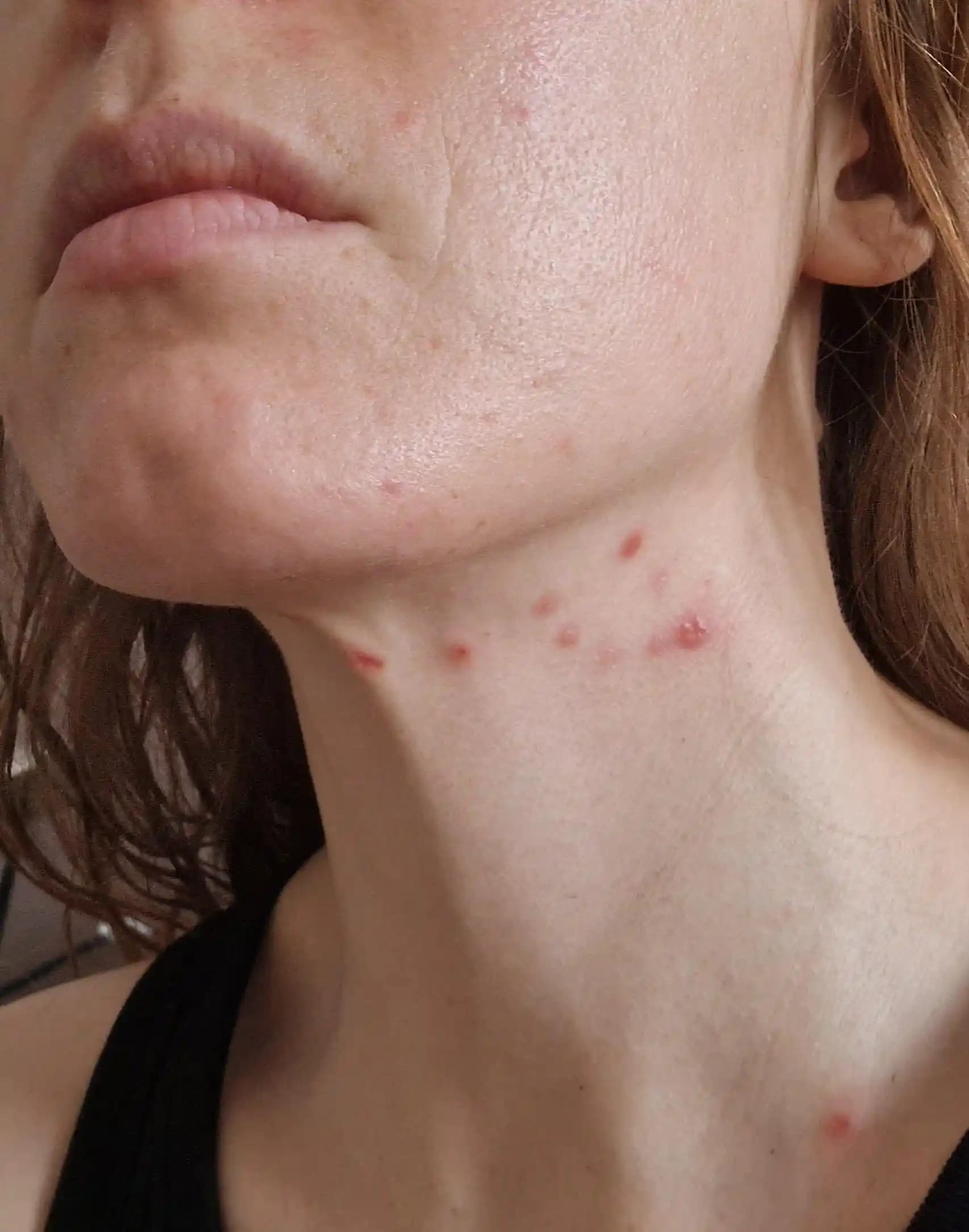 Yetişkinlikte Artan Akne: Nedenleri, Tedavi Yöntemleri ve Dermatolojik Değerlendirme