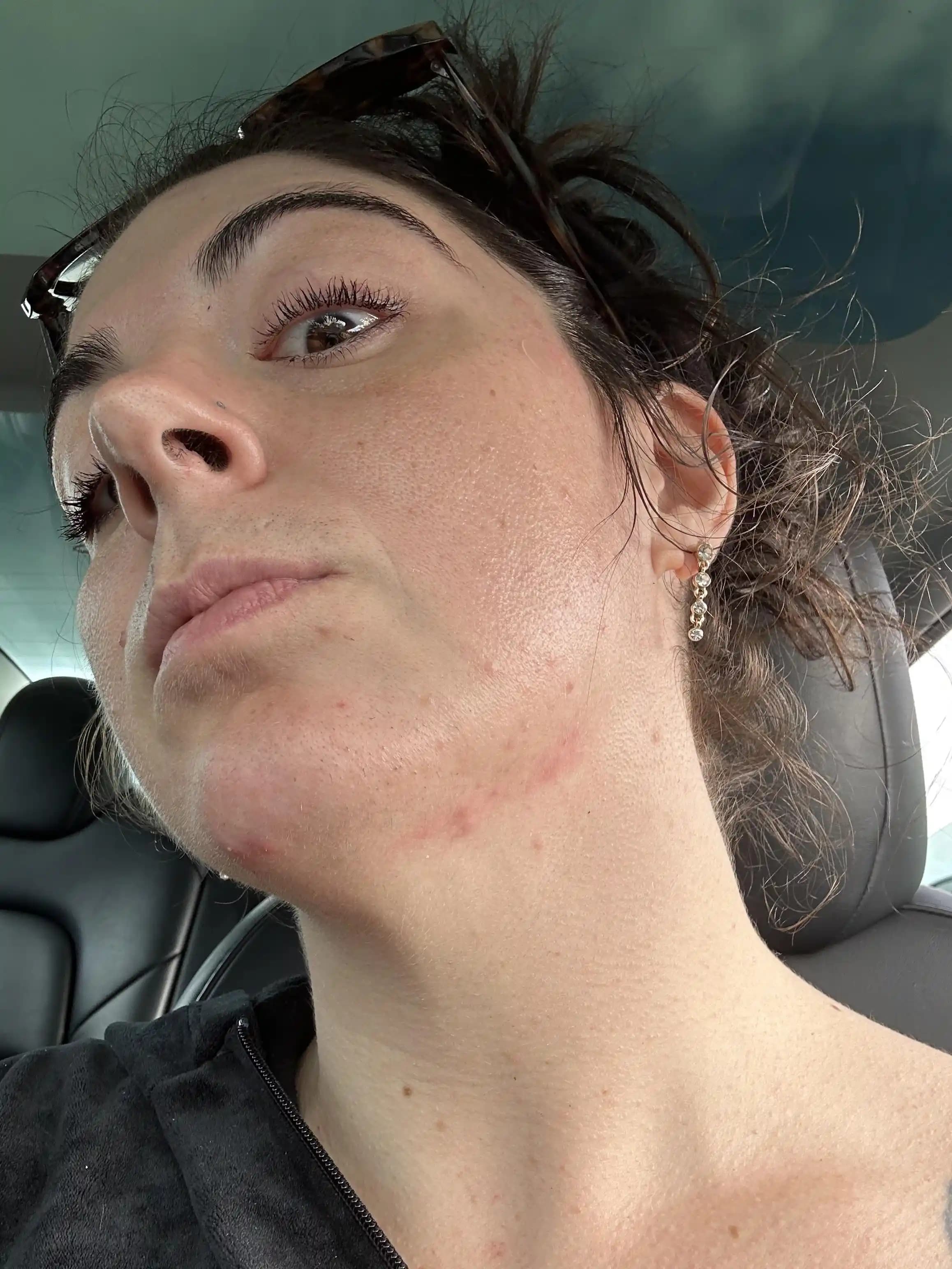 30'lu Yaşlarda Hormonal Akne ve Cilt Sorunları: Nedenleri, Tedavileri ve Bakım Önerileri