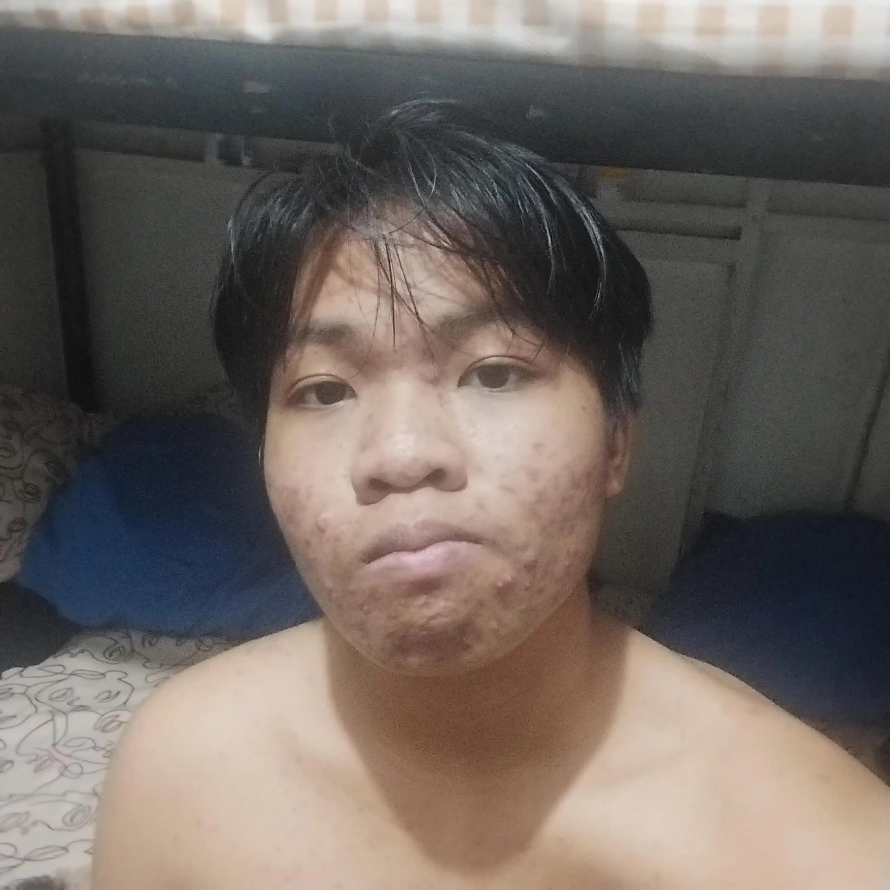 Akne Problemleri ve Evde Uygulanabilir Tedavi Yöntemleri: Dermatolog Olmadan Cilt Bakımı