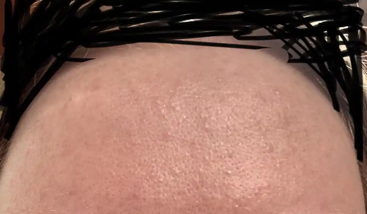 Alında Görülen Küçük Tümseklerin Nedenleri ve Etkili Tedavi Yöntemleri