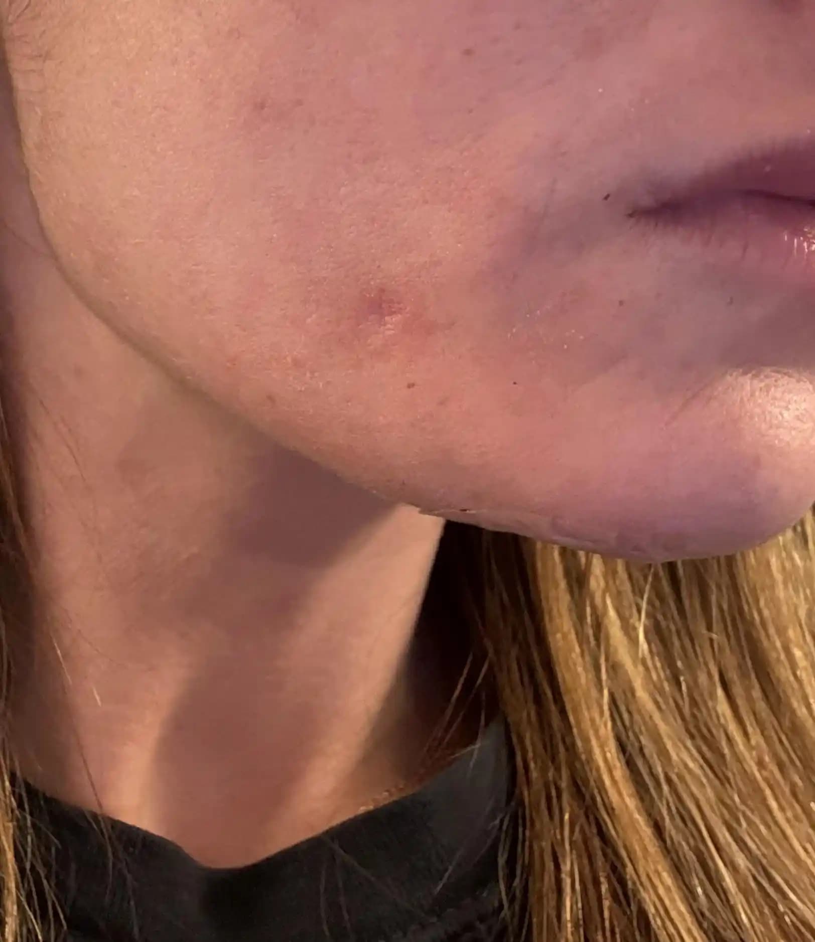 Dermatolojik Steroid Enjeksiyonları Sonrası Yüzde Oluşan Çöküntülerin Nedenleri ve Tedavi Yöntemleri