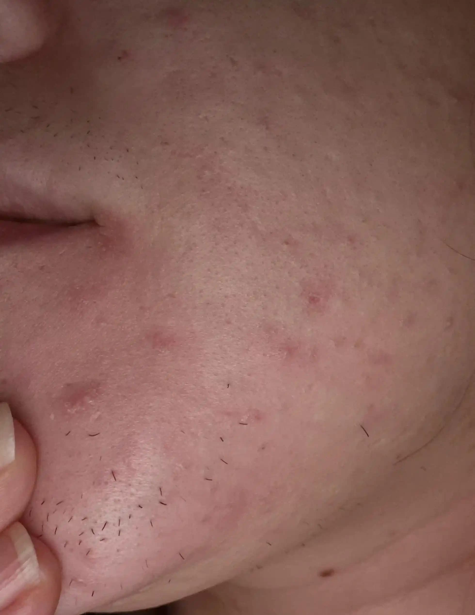 Hirutizm ve Ciltte Sert Yumruların Nedenleri ile Tedavi Yöntemleri Üzerine İnceleme