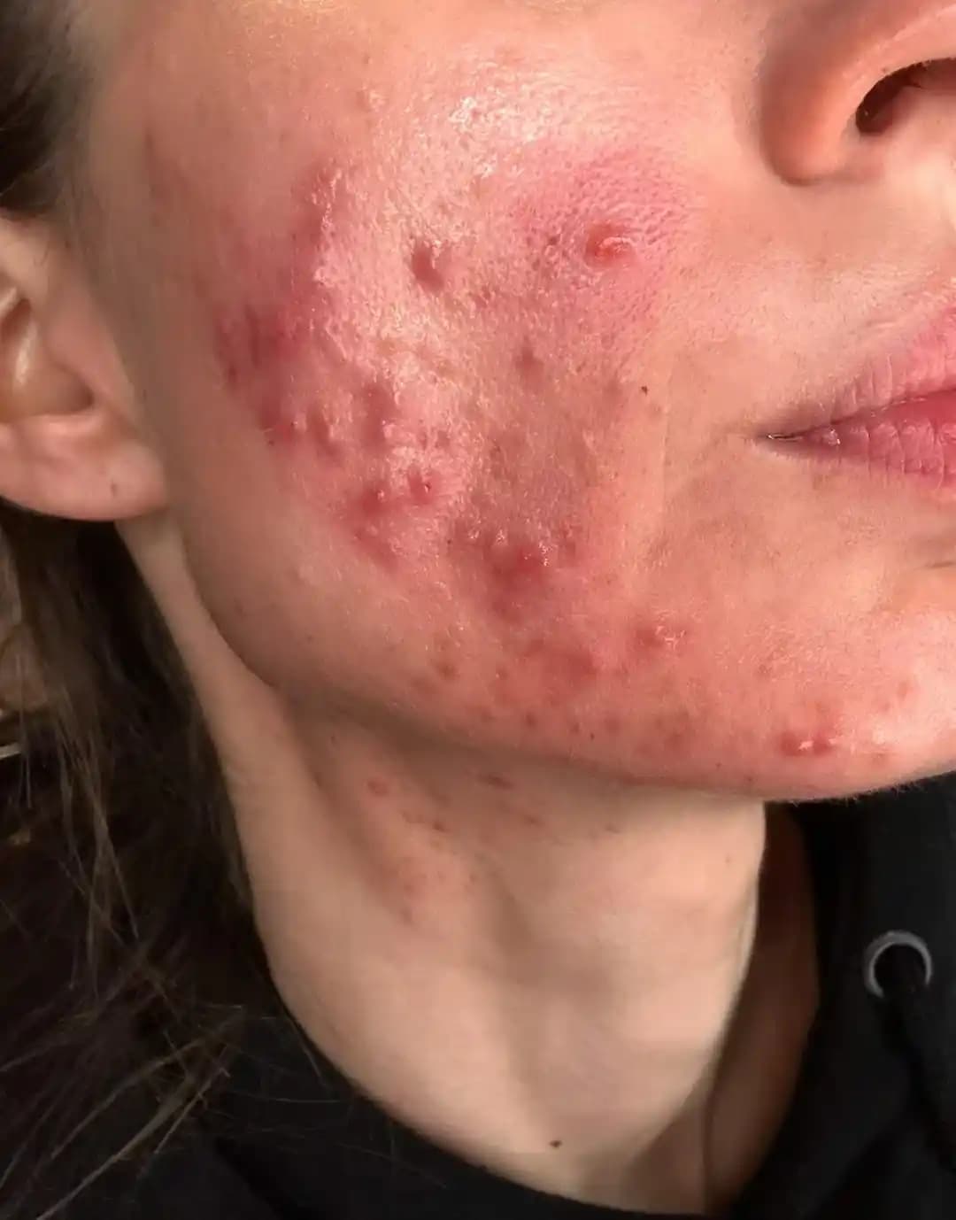 Kistik Akne Sonrası Cilt Kuruluğu ve Doku Problemleri: İyileşme ve Bakım Yöntemleri