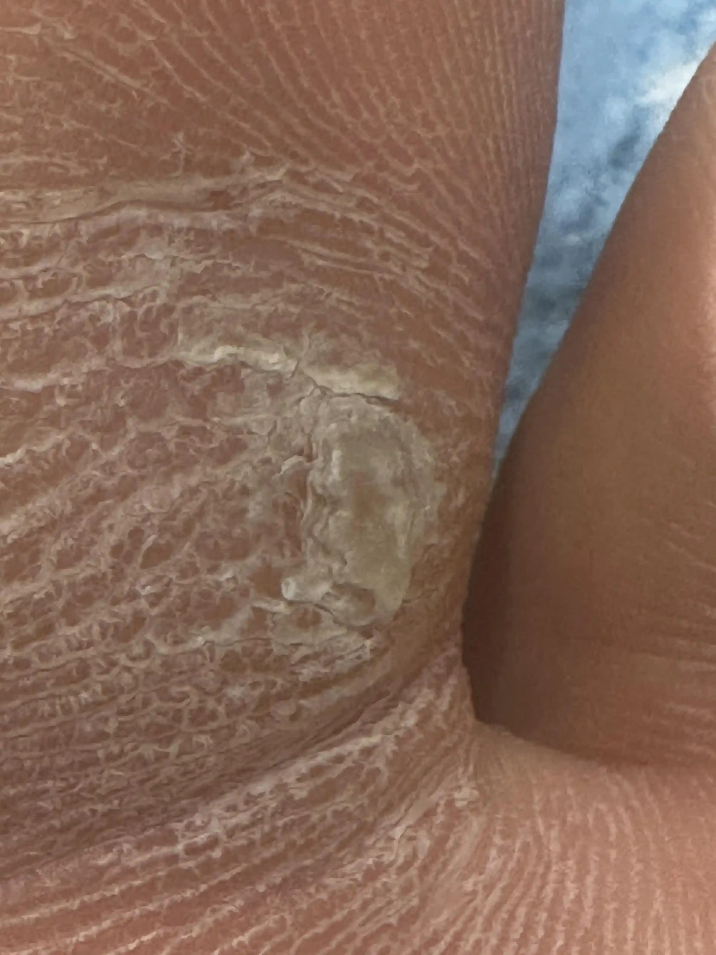 Nasır ve Sertleşmiş Ayak Derisini Yumuşatmak İçin Etkili ve Doğru Bakım Yöntemleri